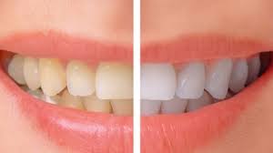 Snowhite Teeth Whitening - Amazon - recensioner - resultat